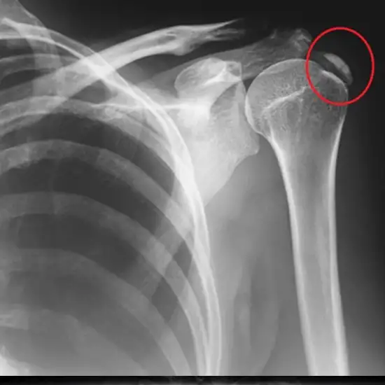 X-ray Left Shoulder Joint AP